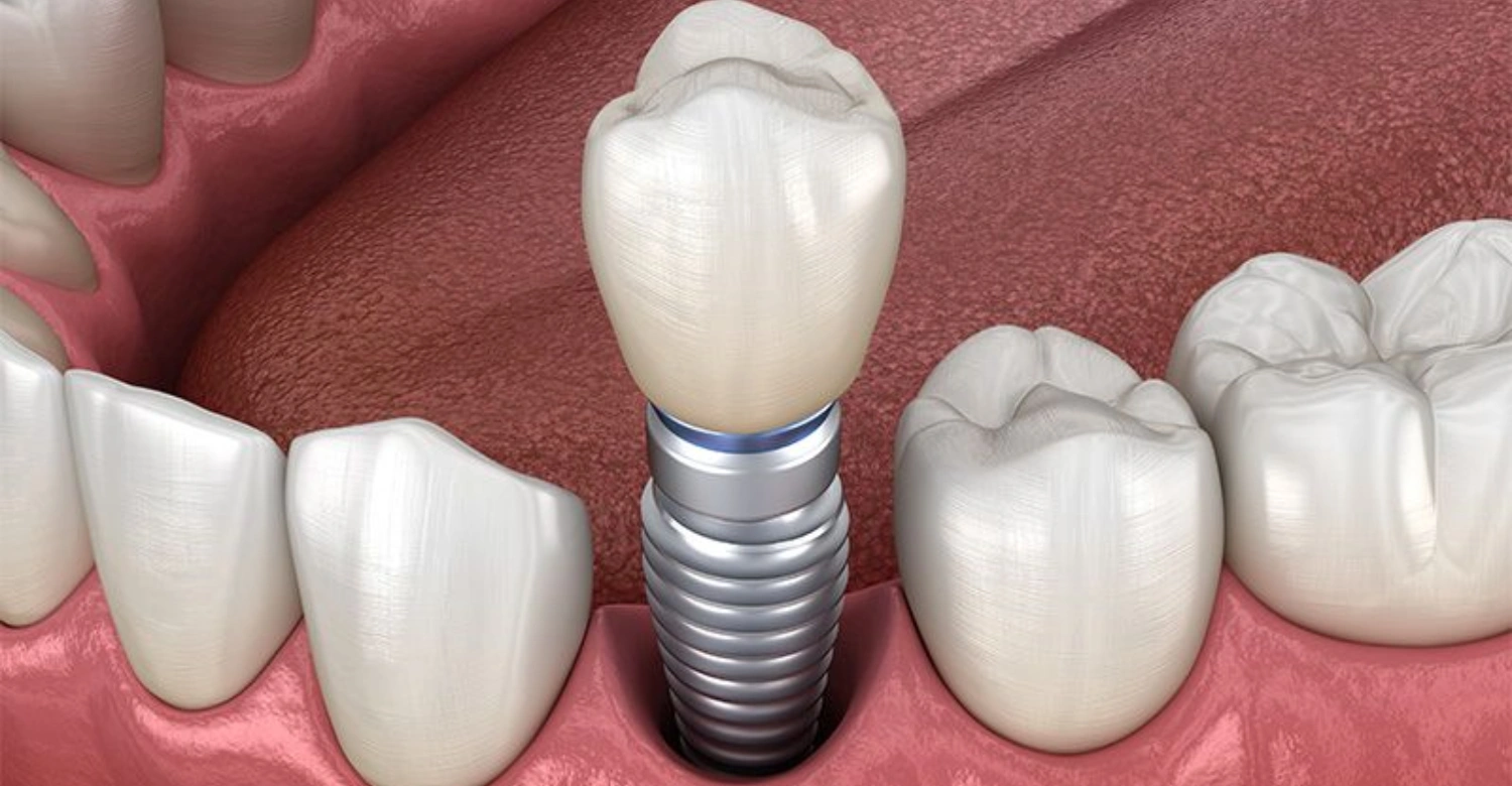 How much do dental implants cost in Turkey